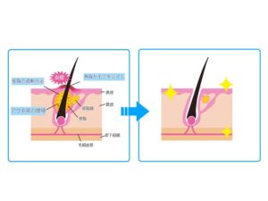 毛穴ケア