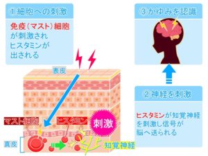 アトピー性皮膚炎