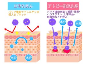 アトピー性皮膚炎