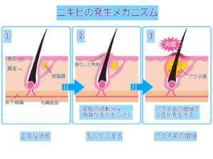 ニキビ発生のメカニズム